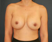 Feel Beautiful - Breast Asymmetry 105 - After Photo